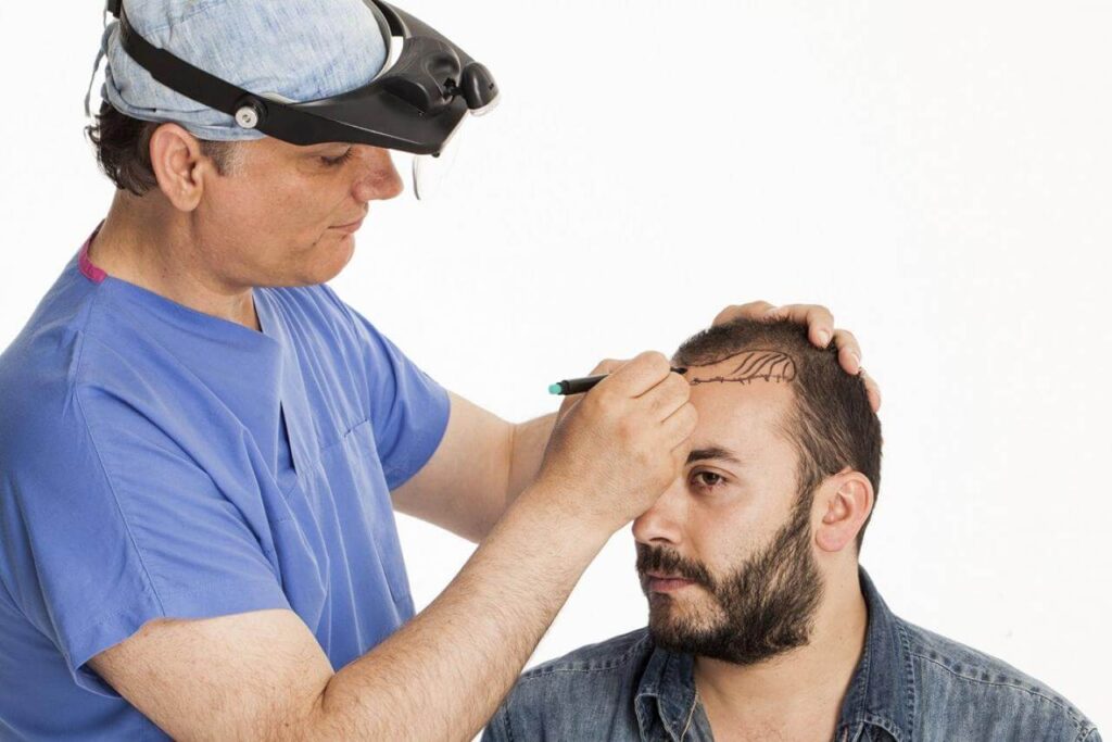 It's a type of surgery that moves hair you already have to fill an area with thin or no hair. Doctors have been doing these transplants in the U.S. since the 1950s, but techniques have changed a lot in recent years. You usually have the procedure in the doctor's office. First, the surgeon cleans your scalp and injects medicine to numb the back of your head. Your doctor will choose one of two methods for the transplant: follicular unit strip surgery (FUSS) or follicular unit extraction (FUE). With FUSS, the surgeon removes a 6- to 10-inch strip of skin from the back of your head. They set it aside and sews the scalp closed. This area is immediately hidden by the hair around it.