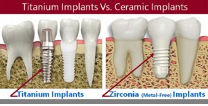 foro implantes dentales precios 2022