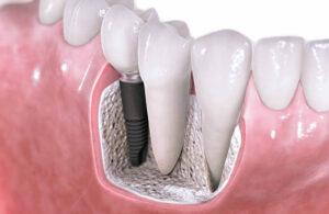 implantes dentales por 250 euros
