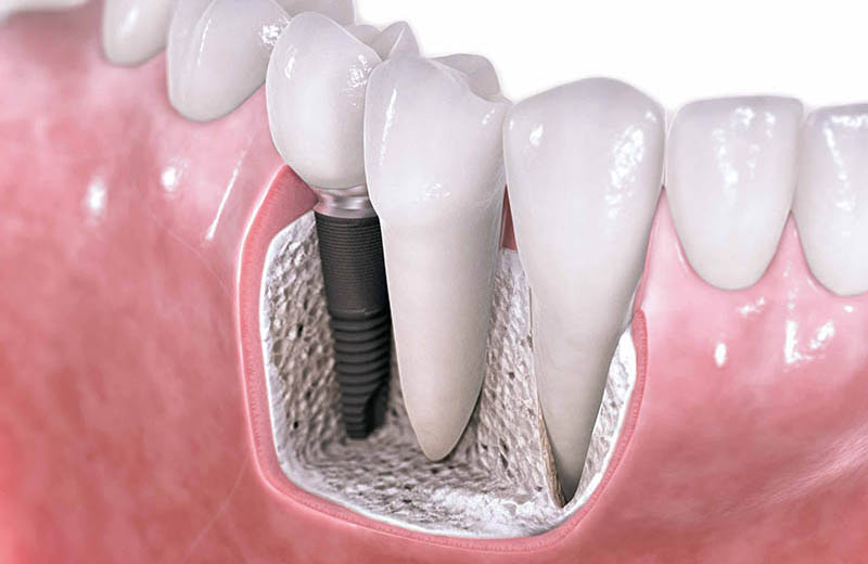 implantater til tandlæger for 250 euro