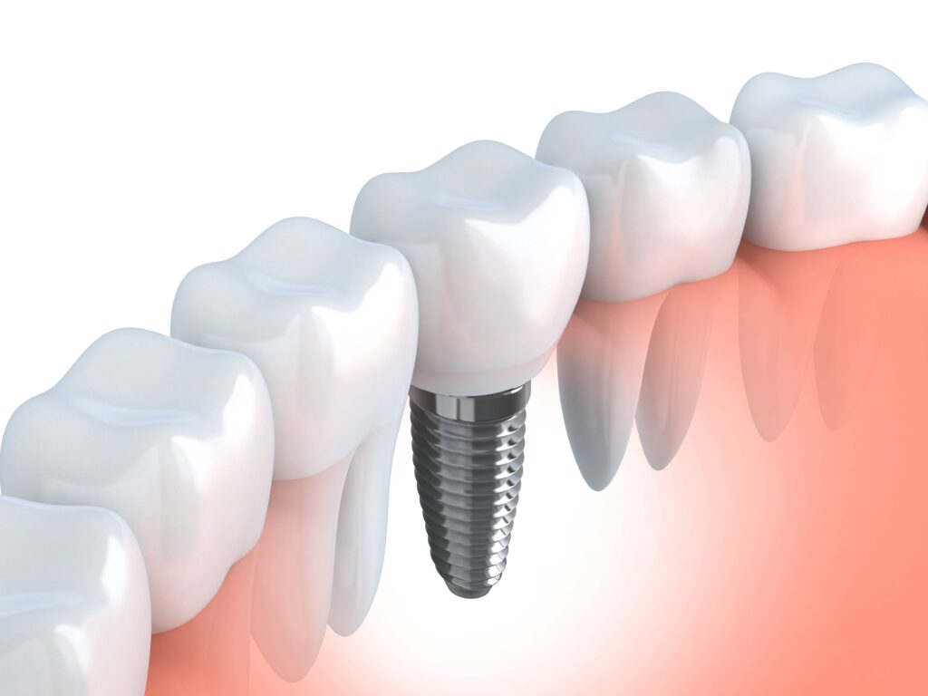 implantes dentales precios 2022