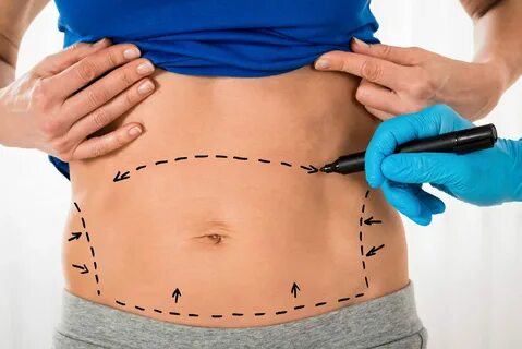 liposucción abdomen