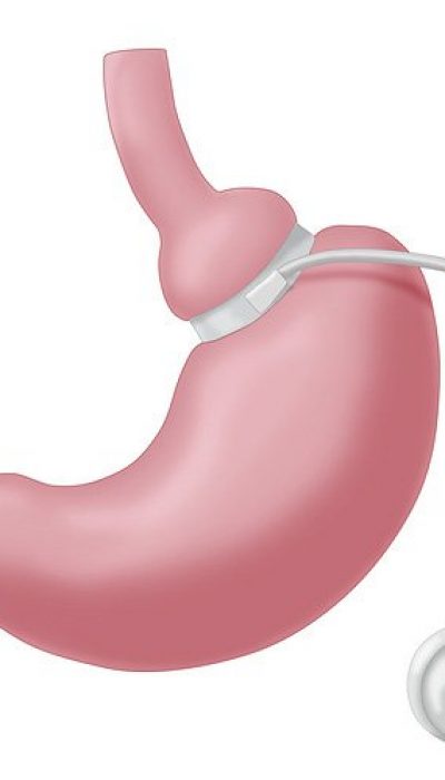 chirurgie de l'anneau gastrique